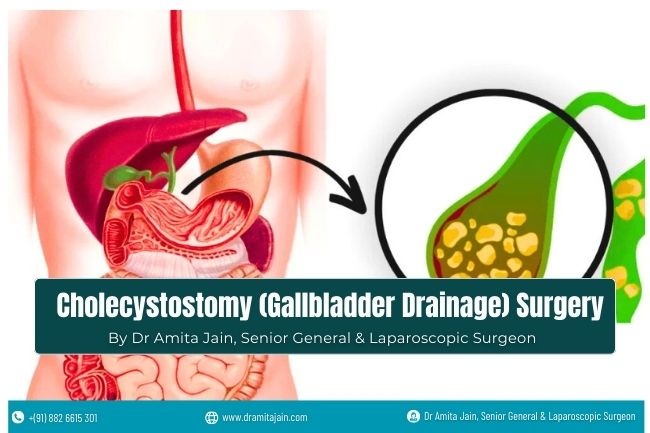 Gallbladder Surgeon Dr Amita Jain Cholecystostomy Gallbladder Drainage Surgeon - Dr Amita Jain